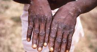 Quarantines For ‘Monkeypox’ Begin In Belgium As First Case Is Detected In New York