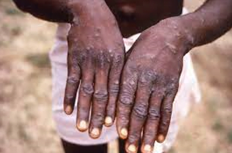 Quarantines For ‘Monkeypox’ Begin In Belgium As First Case Is Detected In New York