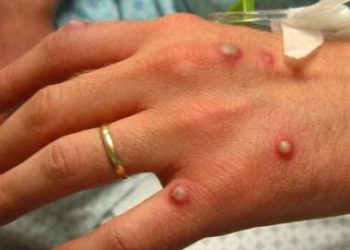 CDC Recommends Masks For Monkeypox That Spreads Through Sex, Close Personal Contact