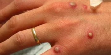 CDC Recommends Masks For Monkeypox That Spreads Through Sex, Close Personal Contact